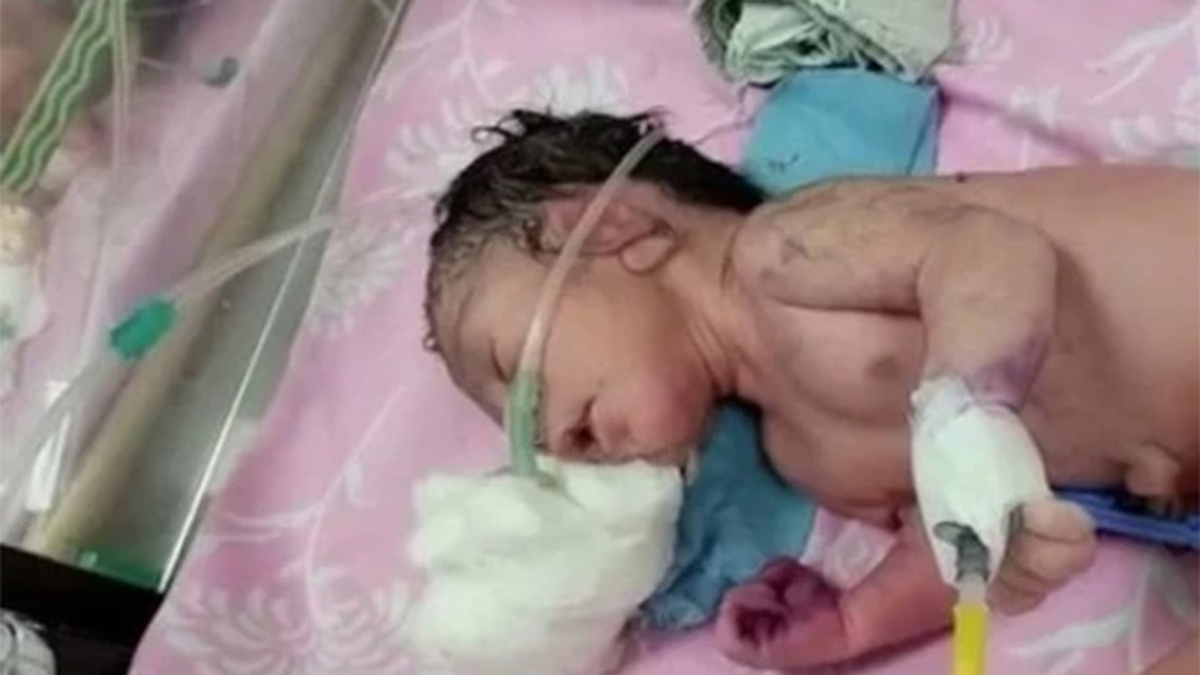 Un bebé nació con un cuerno en lugar de piernas