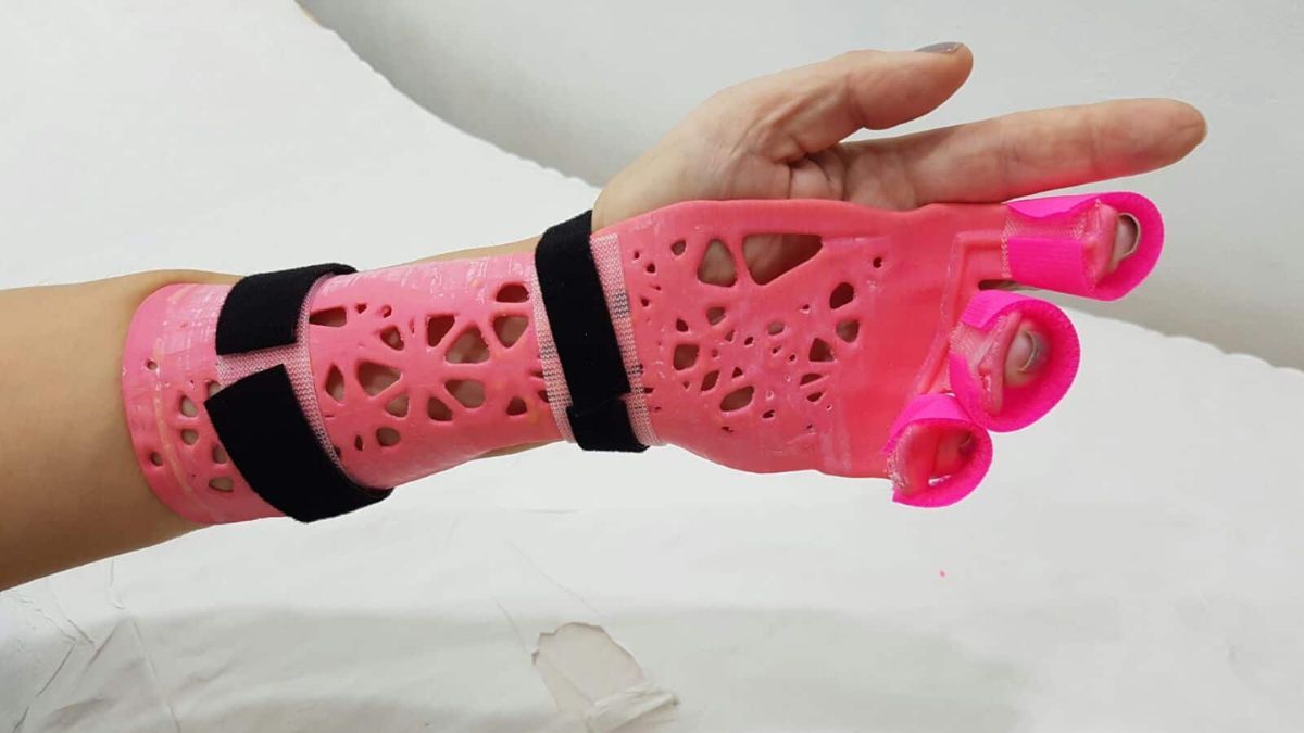 Las férulas ortopédicas termoformadas se producen mediante impresión 3D. Los detalles de la campaña solidaria en Santa Fe.