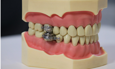 Crean un método polémico para adelgazar: cierran los dientes con un candado Crean un método polémico para adelgazar: cierran los dientes con un candado