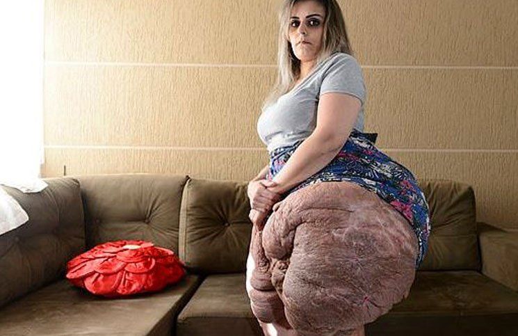 La vida de una mujer que es “consumida” por sus gigantes tumores