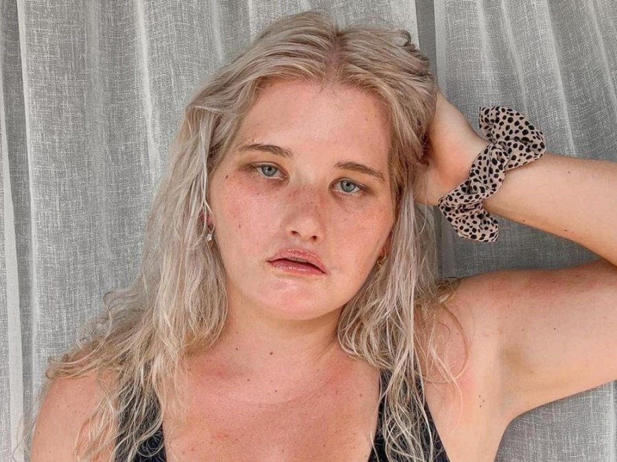 Sufre un extraño síndrome que no le permite sonreír y ahora trabaja de modelo