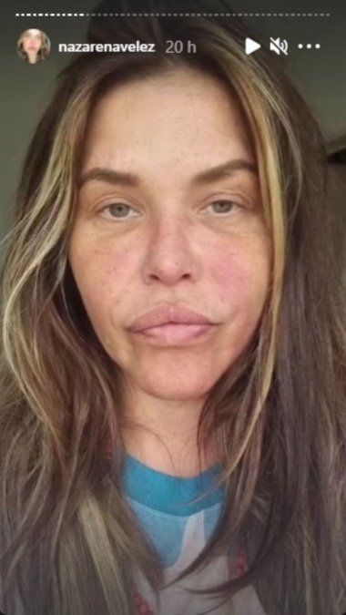 Nazarena Vélez tuvo una reacción alérgica: