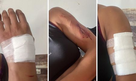 La mujer presenta lesiones en distintas partes de su cuerpo. La mujer presenta lesiones en distintas partes de su cuerpo.