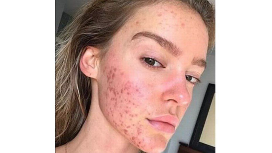 El secreto de esta joven modelo para combatir el acné de su cara
