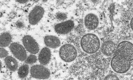 Preocupa el avance de la viruela del mono en el mundo. Preocupa el avance de la viruela del mono en el mundo.