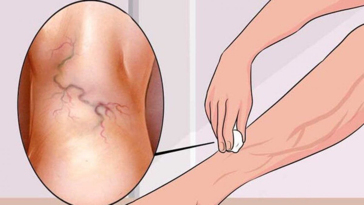 Remedios naturales para mejorar el aspecto de las várices.