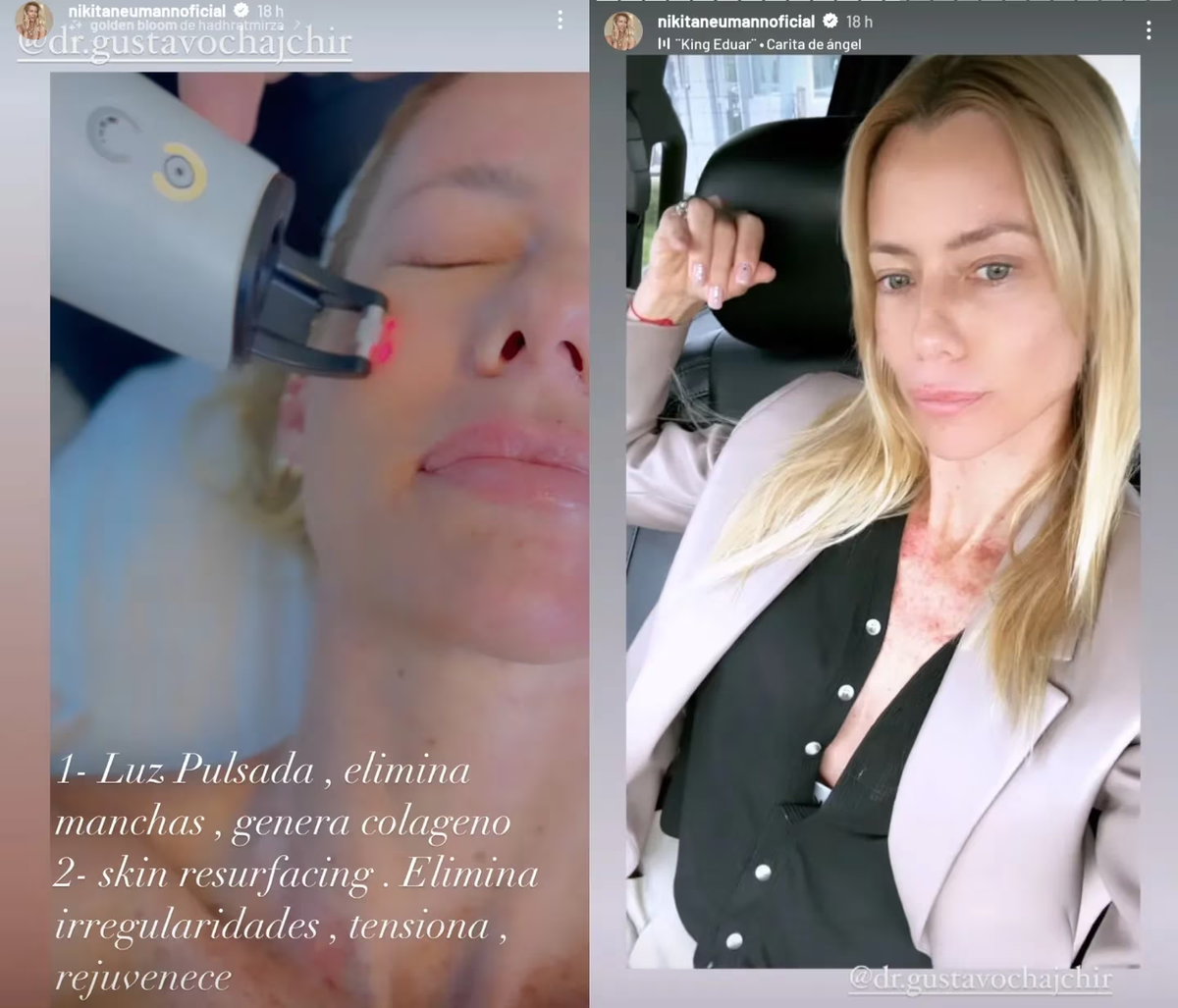 Nicole Neumann se sometió a un procedimiento estético.