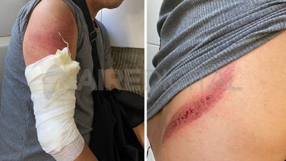 Un bache sobre López y Planes originó un fuerte accidente entre dos motos con tres personas heridas