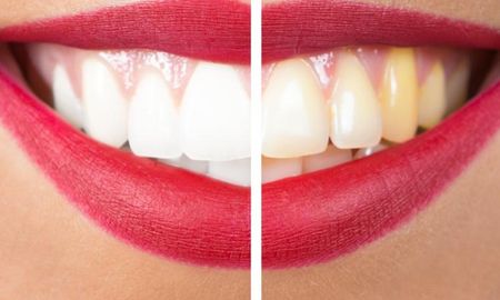 Remedios caseros para blanquear los dientes
