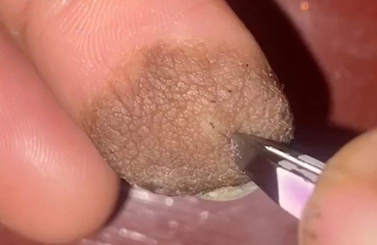 Le injertaron piel en la mano y ahora le crece vello púbico en la yema del dedo