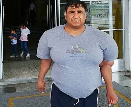 El extraño caso del buzo peruano que tiene el cuerpo “inflado” desde hace cuatro años