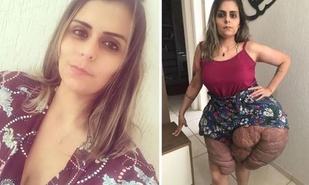 Una enfermedad genética le duplicó el tamaño de las piernas y debe operarse cada tres años