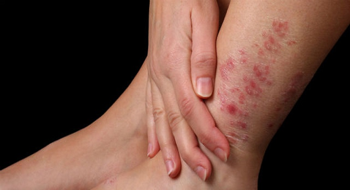 La psoriasis es una enfermedad crónica que causa inflamación y descamación de la piel, pero no es contagiosa.