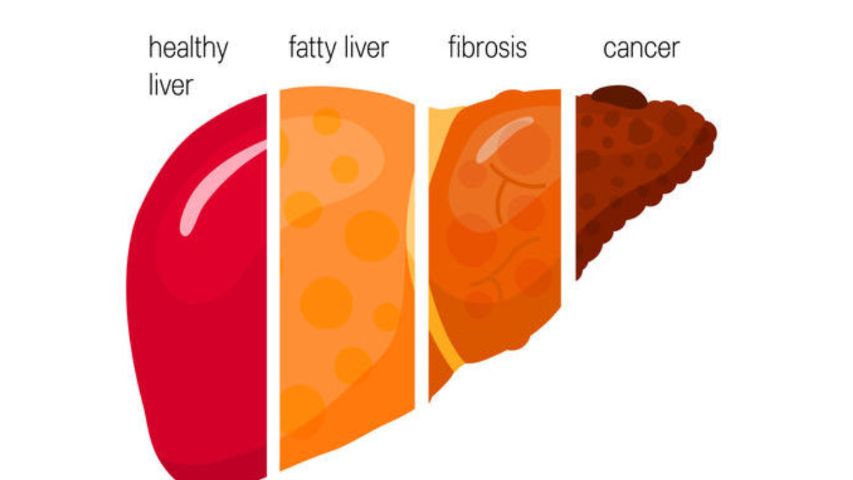 La evolución desde un hígado sano hacia la fibrosis demuestra la importancia de actuar sobre los factores de riesgo metabólicos de manera urgente. (2)