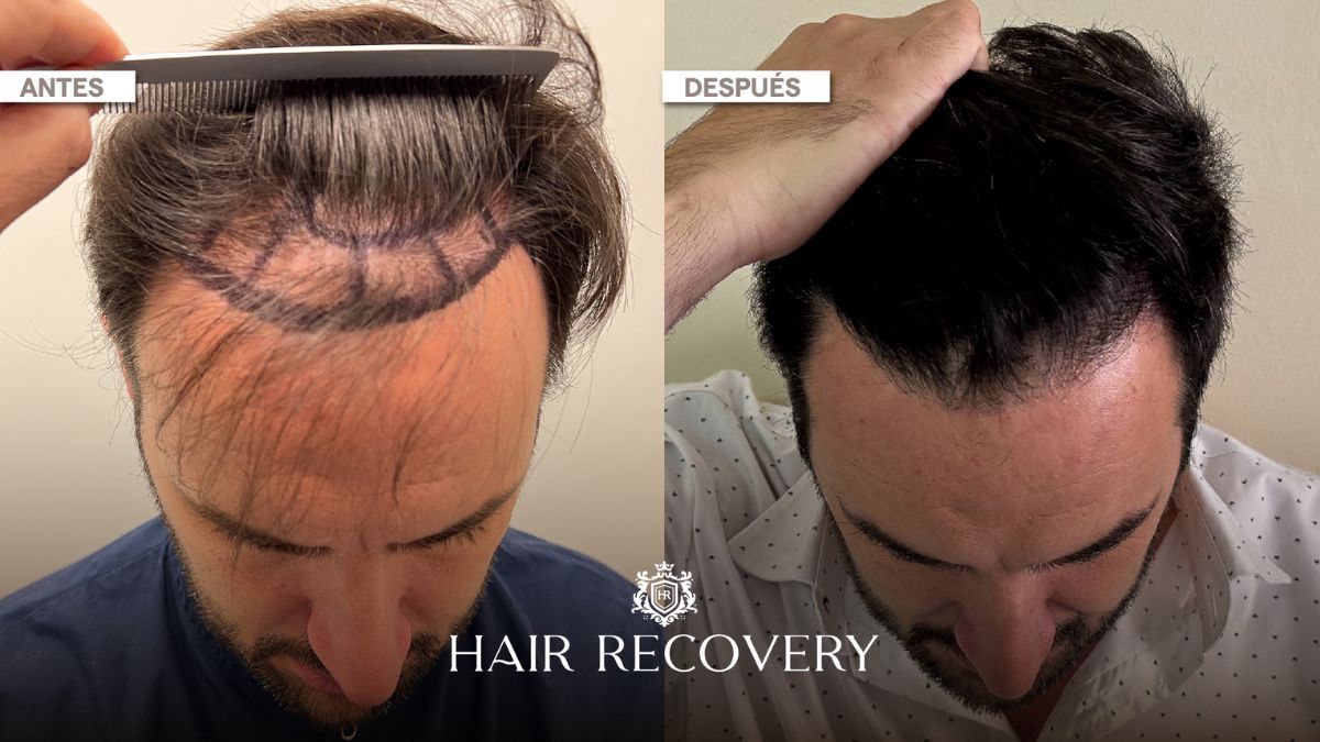 El antes y el después de un microtrasplante capilar pelo por pelo, con resultados sumamente naturales. El antes y el después de un microtrasplante capilar pelo por pelo, con resultados sumamente naturales.