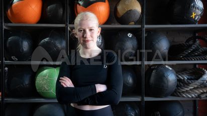 Albinismo: pelo blanco, piel y visión sensible que esconden una gran fortaleza