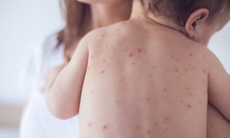 Los síntomas del sarampión incluyen fiebre alta, erupciones cutáneas, conjuntivitis, tos y secreción nasal. Los síntomas del sarampión incluyen fiebre alta, erupciones cutáneas, conjuntivitis, tos y secreción nasal.