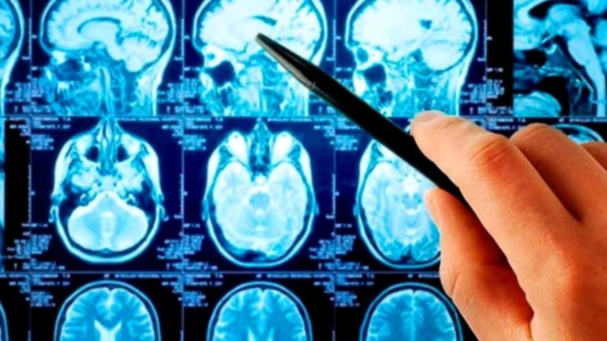 La `niebla mental´ es como una dificultad o falta de concentración.