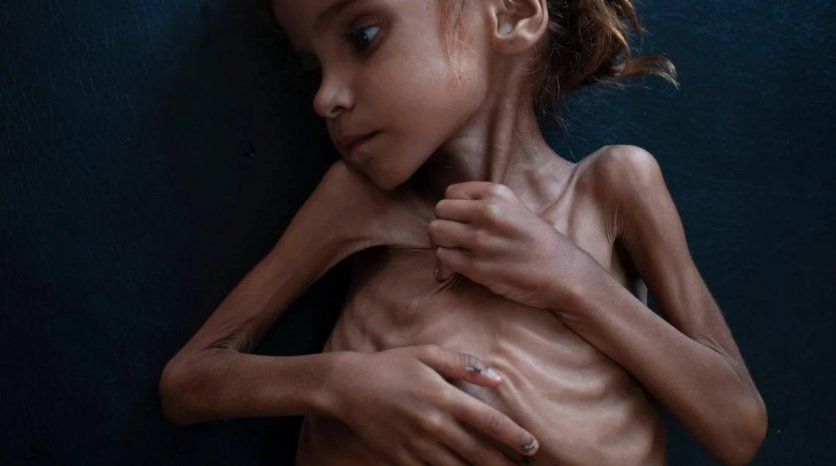 Murió Amal, la nena que se convirtió en símbolo del hambre en Yemen