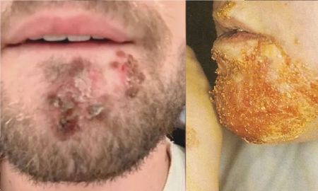 Usó una afeitadora prestada, se contagió una bacteria carnívora y estuvo al borde de la muerte Usó una afeitadora prestada, se contagió una bacteria carnívora y estuvo al borde de la muerte