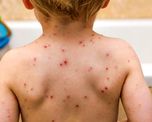 brote de sarampion: ?quienes no sepan si estan vacunados, que se apliquen la dosis?, pide salud brote de sarampion: ?quienes no sepan si estan vacunados, que se apliquen la dosis?, pide salud