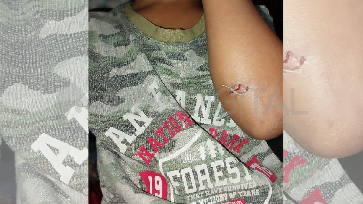 El pequeño se encuentra en su casa donde le realizan curaciones en la herida