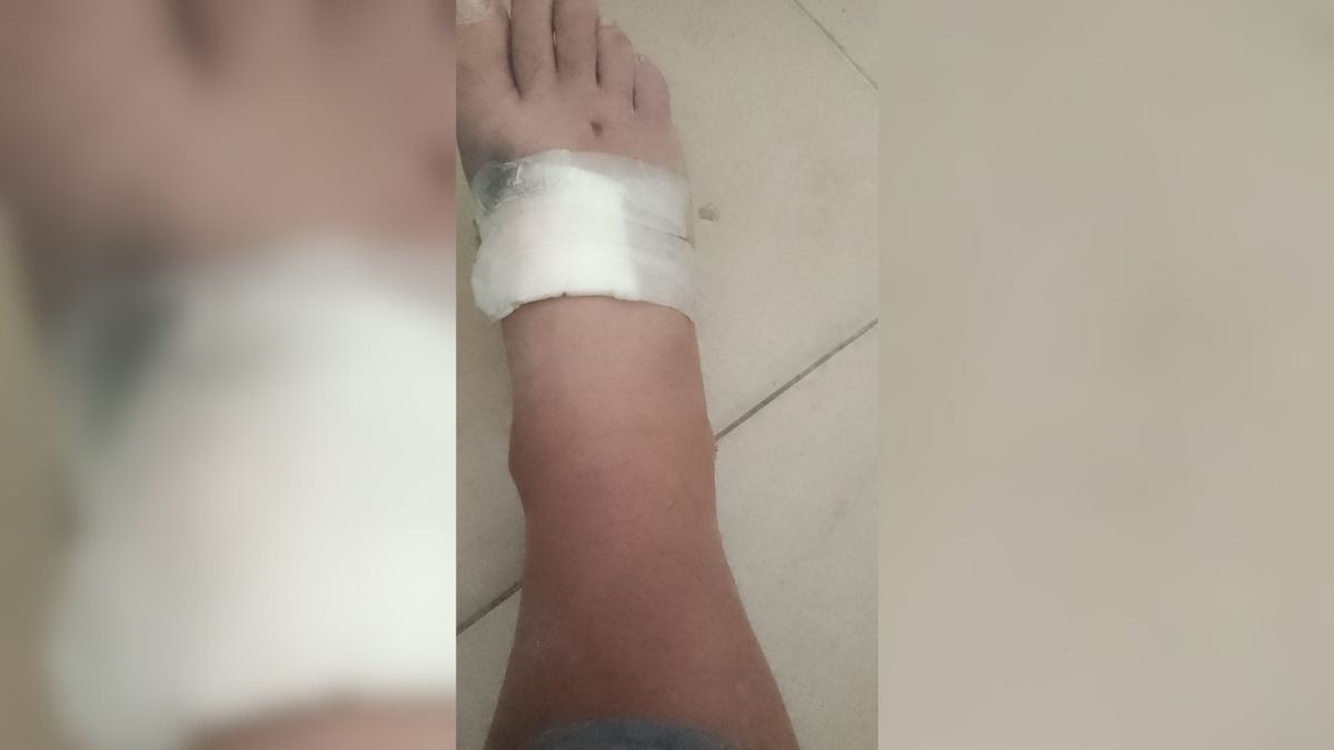 Mario sufrió un fuerte golpe en el empeine del pie derecho. Mario sufrió un fuerte golpe en el empeine del pie derecho.