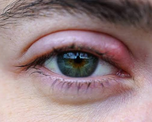 El Staphylococcus aureus es la bacteria más común asociada a la inflamación e infección del folículo palpebral. El Staphylococcus aureus es la bacteria más común asociada a la inflamación e infección del folículo palpebral.