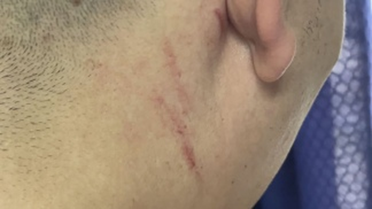 El acusado presentó lesiones compatibles con rasguños.