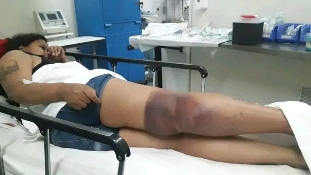 Una joven quiso consultar el saldo de la SUBE y se electrocutó: deberá ser operada