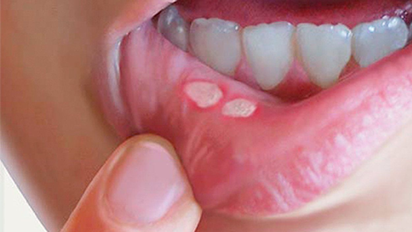 Crecieron más del 40% los contagios de sífilis en Argentina: Santa Fe es el tercer distrito con más casos