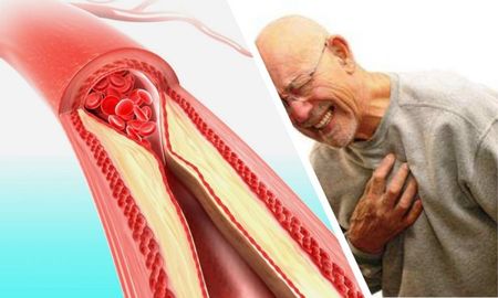 6 remedios naturales para destapar las arterias