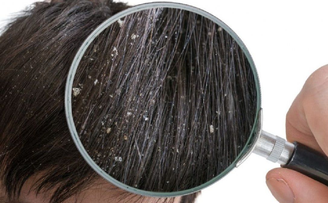 Cómo surge la caspa en nuestro cuero cabelludo
