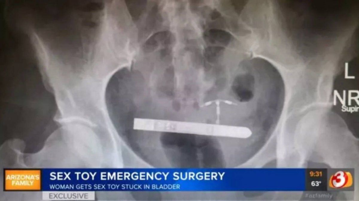 Fue operada de urgencia luego de que se le atascó un vibrador encendido