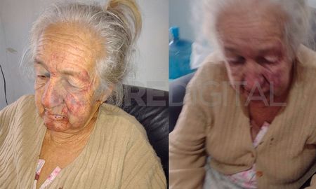 La mujer brutalmente atacada en un robo en su domicilio de barrio Cabal fue intervenida quirúrgicamente debido a las fracturas que le ocasionaron. La mujer brutalmente atacada en un robo en su domicilio de barrio Cabal fue intervenida quirúrgicamente debido a las fracturas que le ocasionaron.