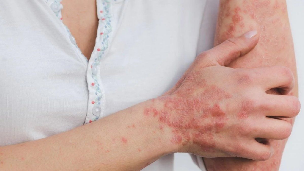 Día Mundial de la Psoriasis: síntomas