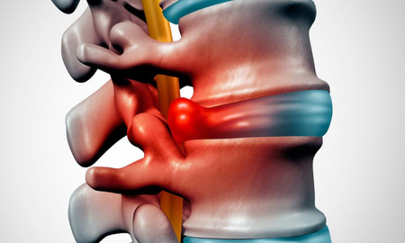 La hernia de disco lumbar hace referencia a un problema con uno de los amortiguadores cartilaginosos (discos) que se encuentran entre los huesos. La hernia de disco lumbar hace referencia a un problema con uno de los amortiguadores cartilaginosos (discos) que se encuentran entre los huesos.