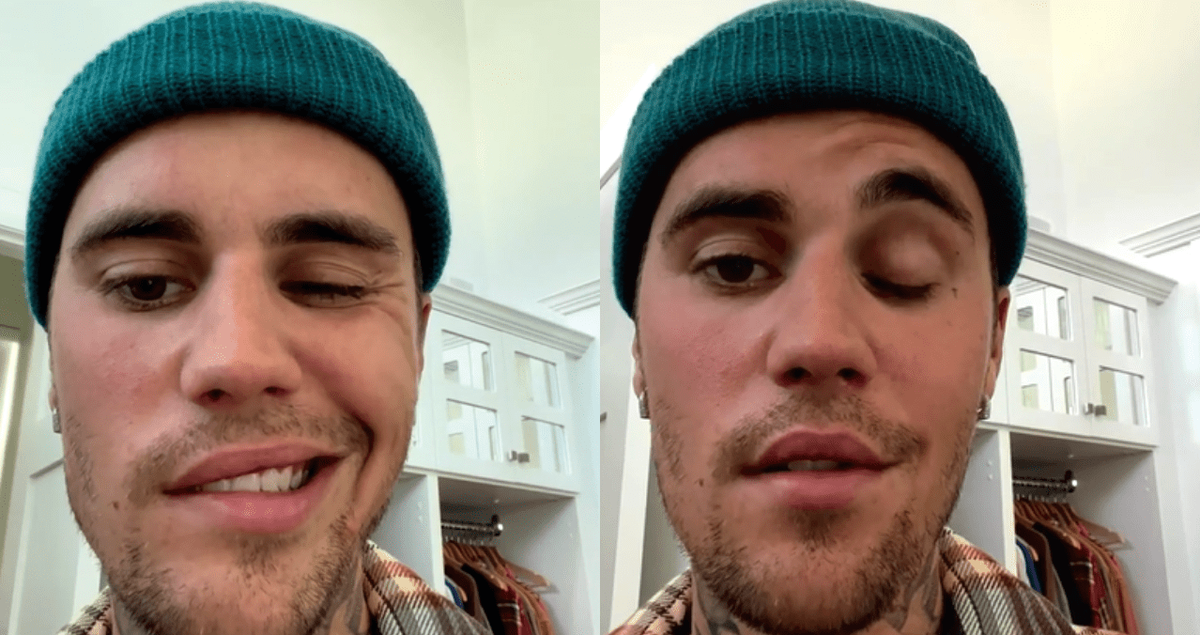 Qué es el síndrome de Ramsay Hunt que sufre Justin Bieber
