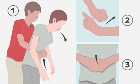 Qué es la Maniobra de Heimlich con la que policías salvaron a un bebé frente a Casa de Gobierno. Qué es la Maniobra de Heimlich con la que policías salvaron a un bebé frente a Casa de Gobierno.