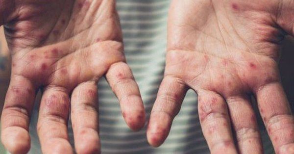 Alerta Nacional por un caso de Sarampión en Rosario