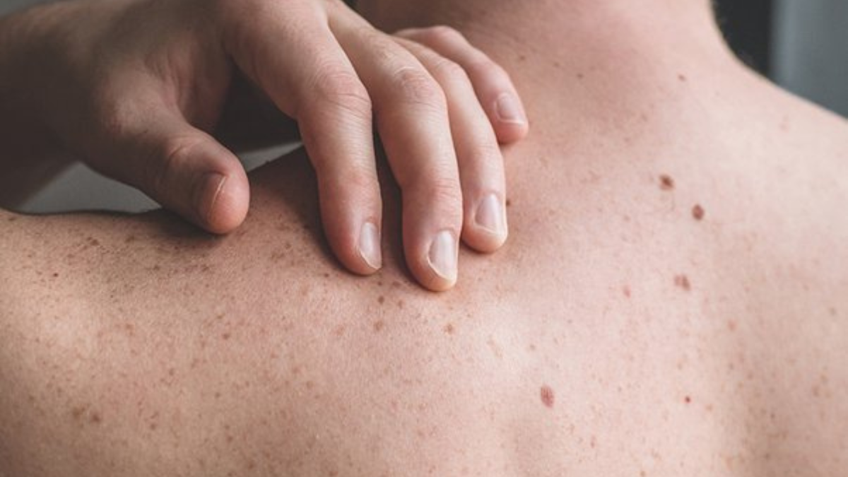 Por año fallecen 50 personas por año en la provincia de Santa Fe a causa del çáncer de melanoma.