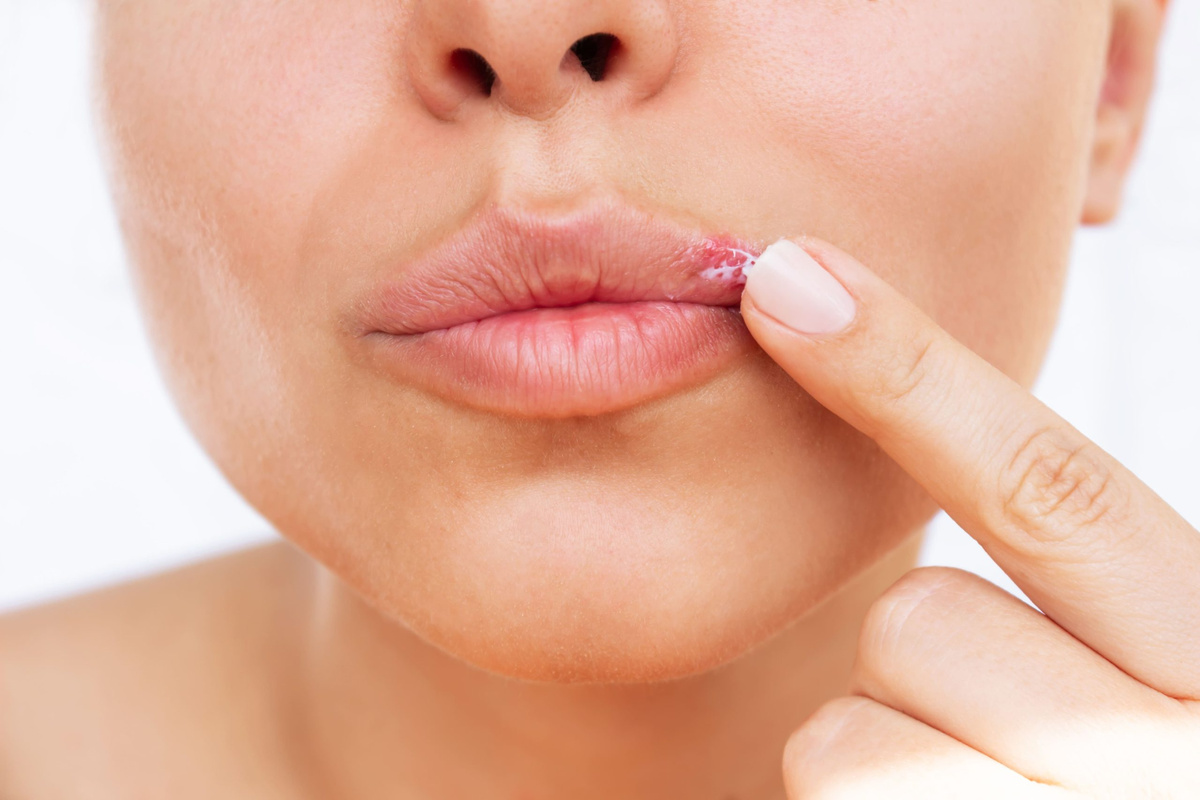 Herpes labial: qué lo causa y cómo aliviar el dolor