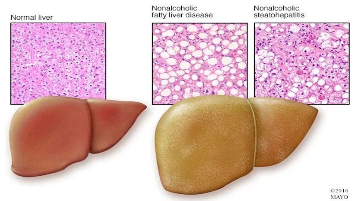 Aunque en sus primeras etapas no genera daño directo, el órgano se agranda y cambia de color, lo que puede ser detectado mediante una ecografía. Aunque en sus primeras etapas no genera daño directo, el órgano se agranda y cambia de color, lo que puede ser detectado mediante una ecografía.