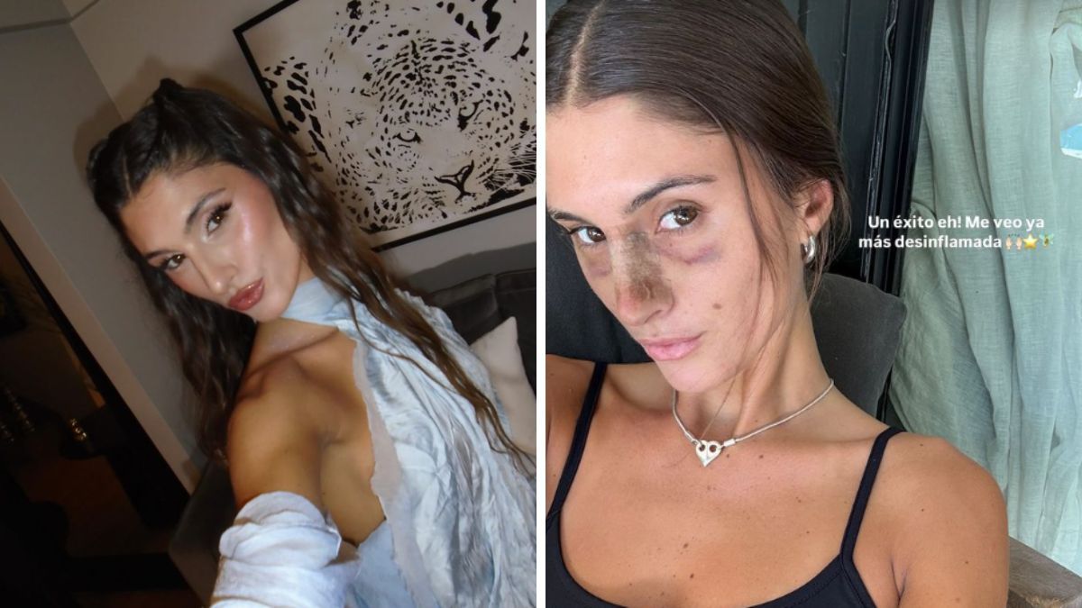 Lola Latorre se operó la nariz días atrás y los cambios ya se notan. Lola Latorre se operó la nariz días atrás y los cambios ya se notan.