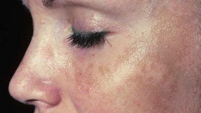 ¿Manchas en la cara? Ojo, puede ser melasma, y te contamos de qué se trata