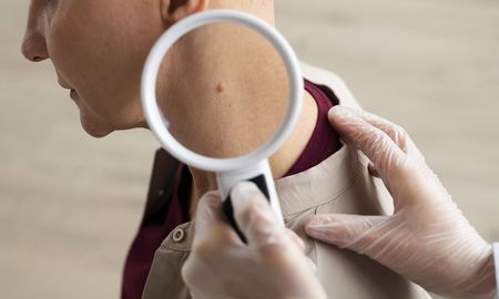 La detección temprana de las lesiones cutáneas favorece la prevención y tratamiento del cáncer de piel. La detección temprana de las lesiones cutáneas favorece la prevención y tratamiento del cáncer de piel.