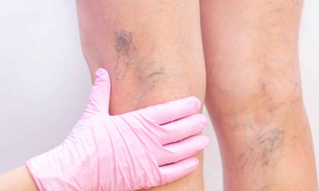 por que aparecen las varices y como prevenirlas con ejercicio fisico por que aparecen las varices y como prevenirlas con ejercicio fisico