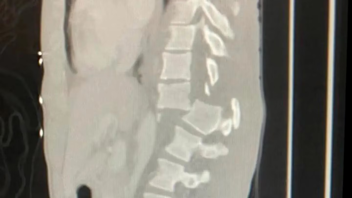 La radiografía que retrata la situación de Facundo. Necesita US$500.000 para volver a Argentina y poder comenzar su rehabilitación.