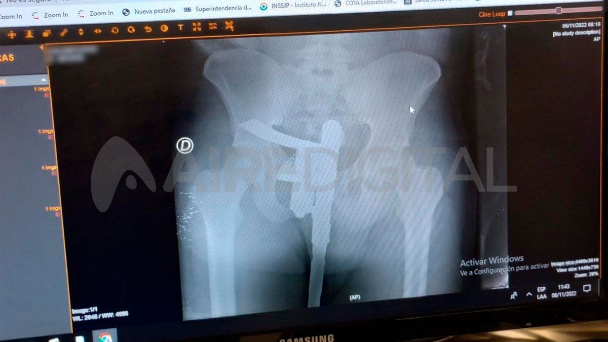 Tuvo un accidente y lo llevaron al Hospital Cullen: tenía un arma de fuego en los genitales.