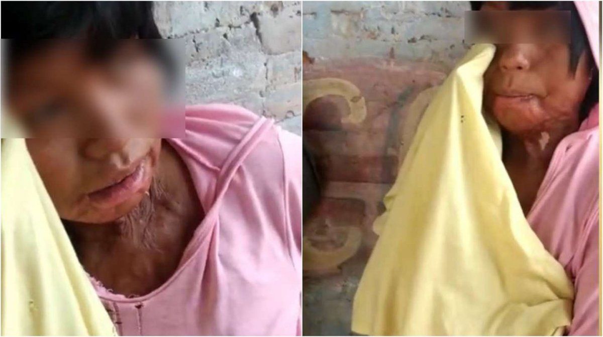 Una joven wichí que sufrió quemaduras al inhalar nafta. (Foto: captura de video El Tribuno).